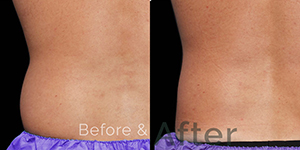 Arms Fat Removal Treatment