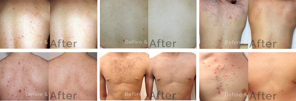 Luminous back peel Before and After